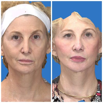 Facelift Before & After Gallery - Patient 14282332 - Image 1