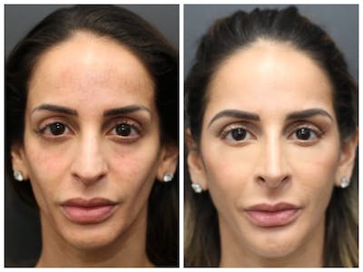 Aesthetic Facial Balancing Before & After Gallery - Patient 11681583 - Image 1