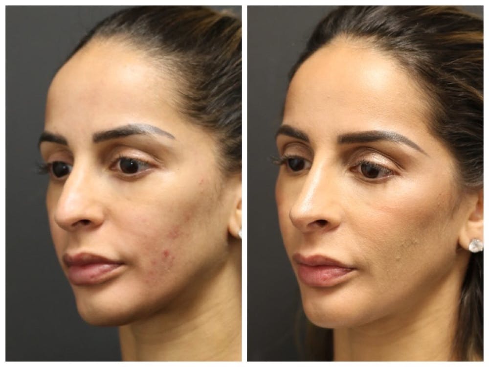 Aesthetic Facial Balancing Before & After Gallery - Patient 11681583 - Image 3