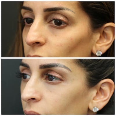Aesthetic Facial Balancing Before & After Gallery - Patient 11681583 - Image 4
