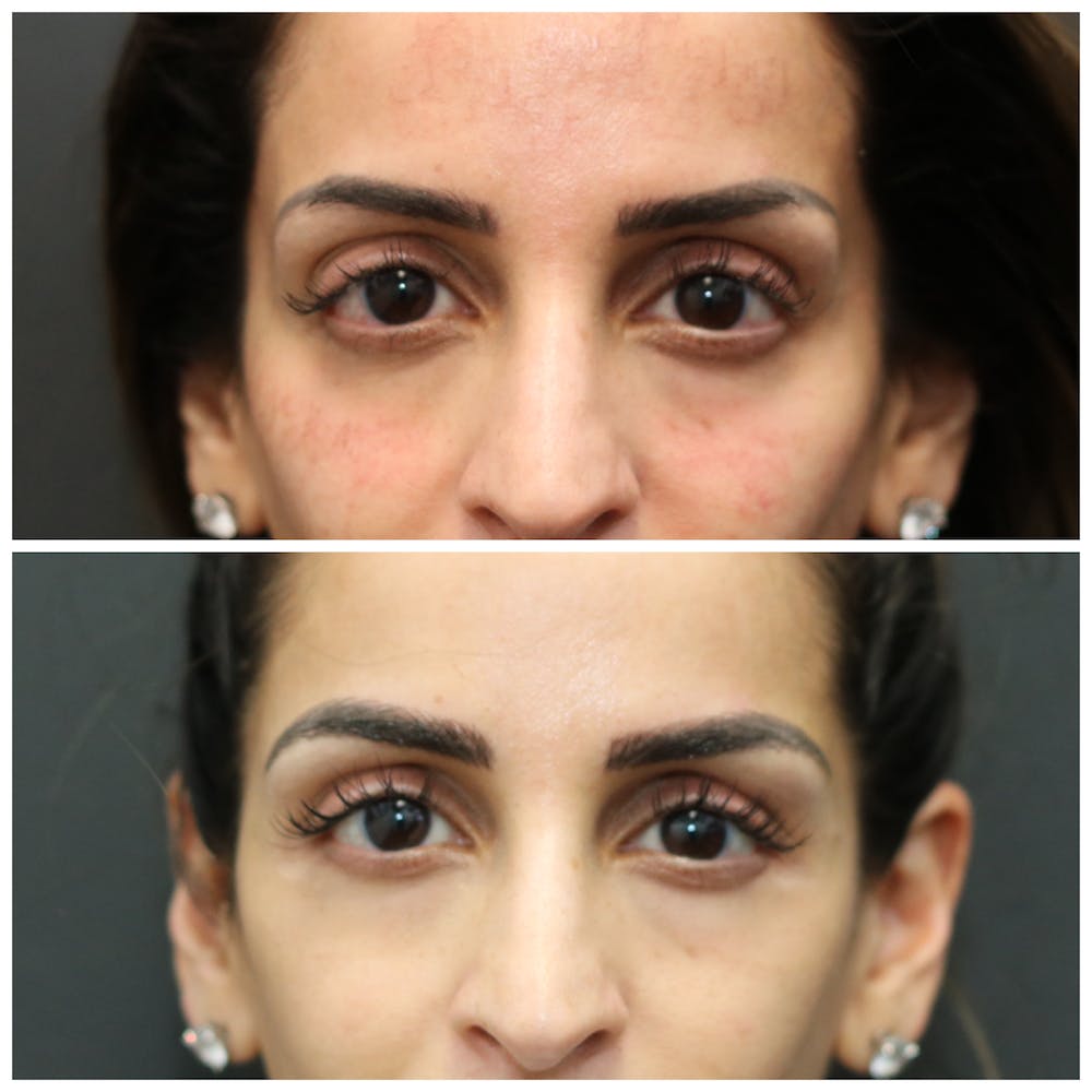 Aesthetic Facial Balancing Before & After Gallery - Patient 11681583 - Image 5