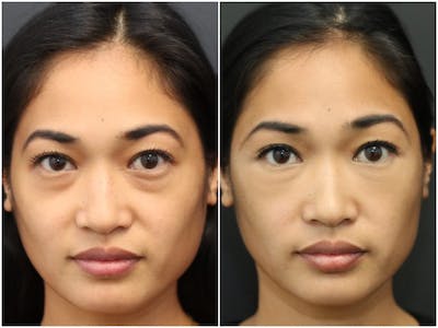 Aesthetic Facial Balancing Before & After Gallery - Patient 11681584 - Image 1