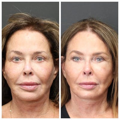 Aesthetic Facial Balancing Before & After Gallery - Patient 11681585 - Image 1