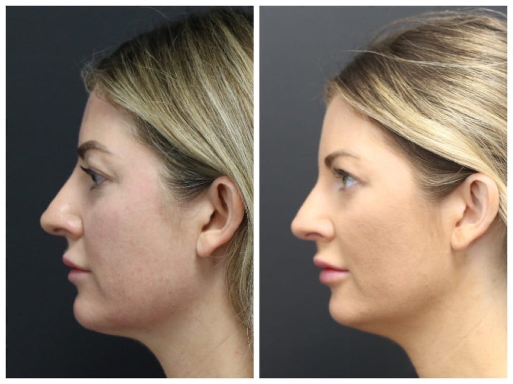 Aesthetic Facial Balancing Before & After Gallery - Patient 11681586 - Image 3