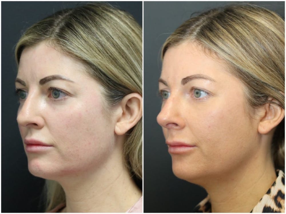 Aesthetic Facial Balancing Before & After Gallery - Patient 11681586 - Image 5