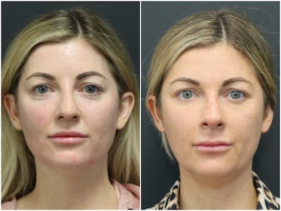 Aesthetic Facial Balancing Before & After Gallery - Patient 11681586 - Image 1