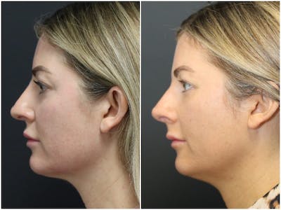 Aesthetic Facial Balancing Before & After Gallery - Patient 11681586 - Image 6