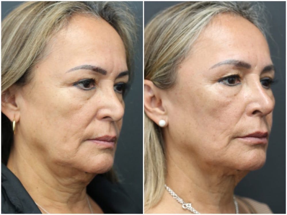 Aesthetic Facial Balancing Before & After Gallery - Patient 11681587 - Image 2
