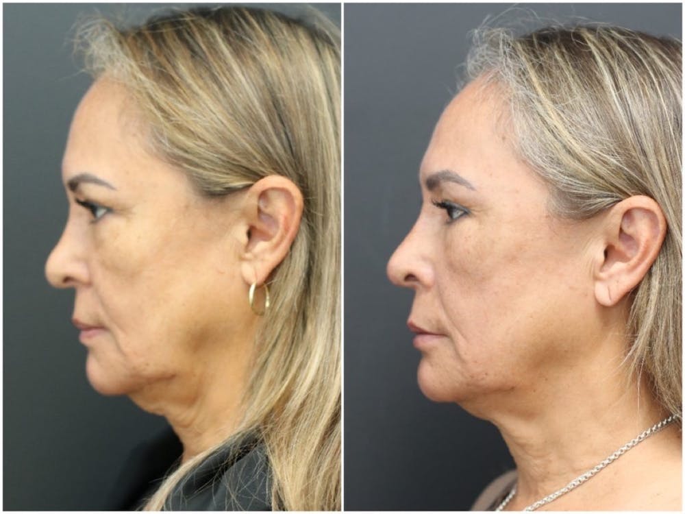 Aesthetic Facial Balancing Before & After Gallery - Patient 11681587 - Image 3