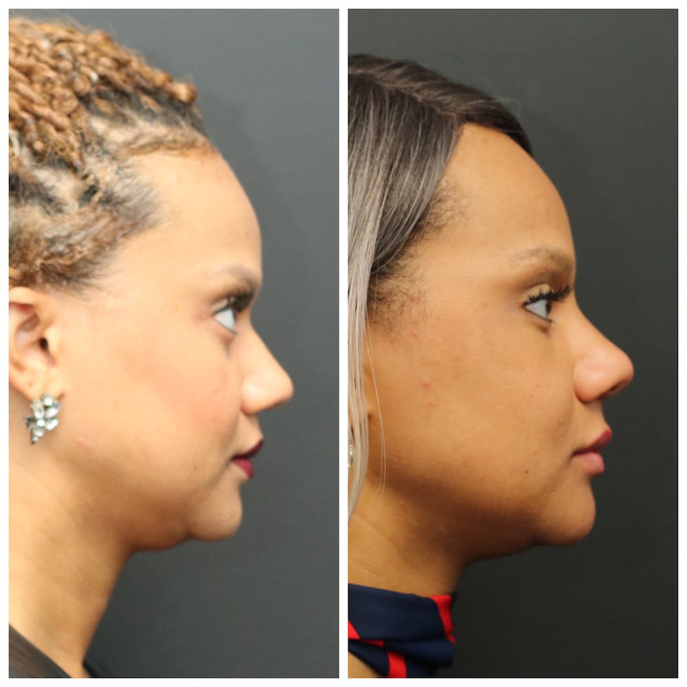 Aesthetic Facial Balancing Before & After Gallery - Patient 11681588 - Image 3