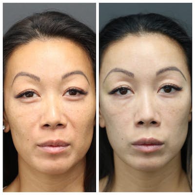 Aesthetic Facial Balancing Before & After Gallery - Patient 11681589 - Image 1