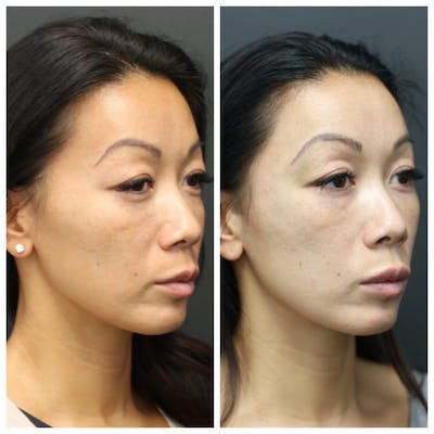 Aesthetic Facial Balancing Before & After Gallery - Patient 11681589 - Image 2