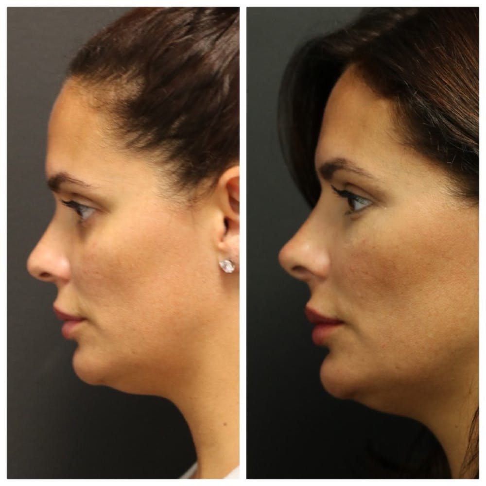 Aesthetic Facial Balancing Before & After Gallery - Patient 11681590 - Image 3