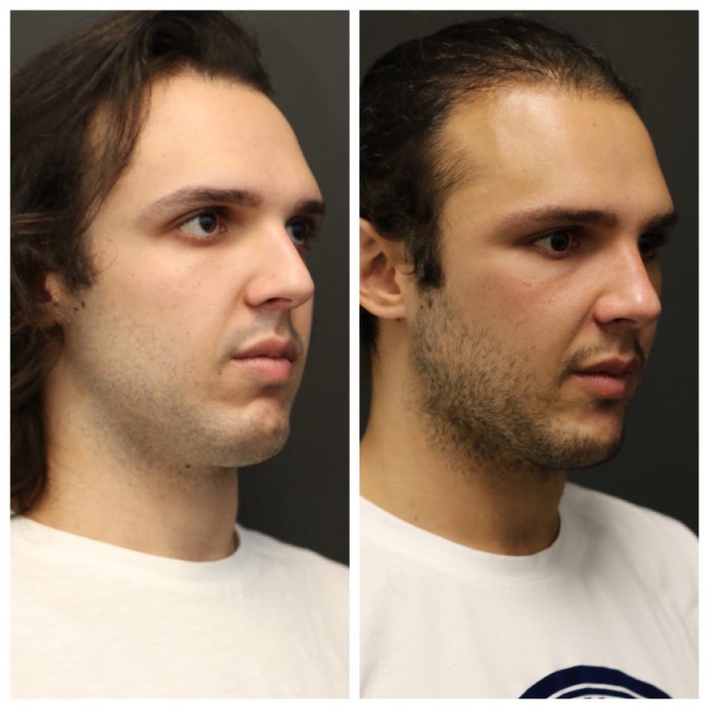 Aesthetic Facial Balancing Before & After Gallery - Patient 11681591 - Image 2