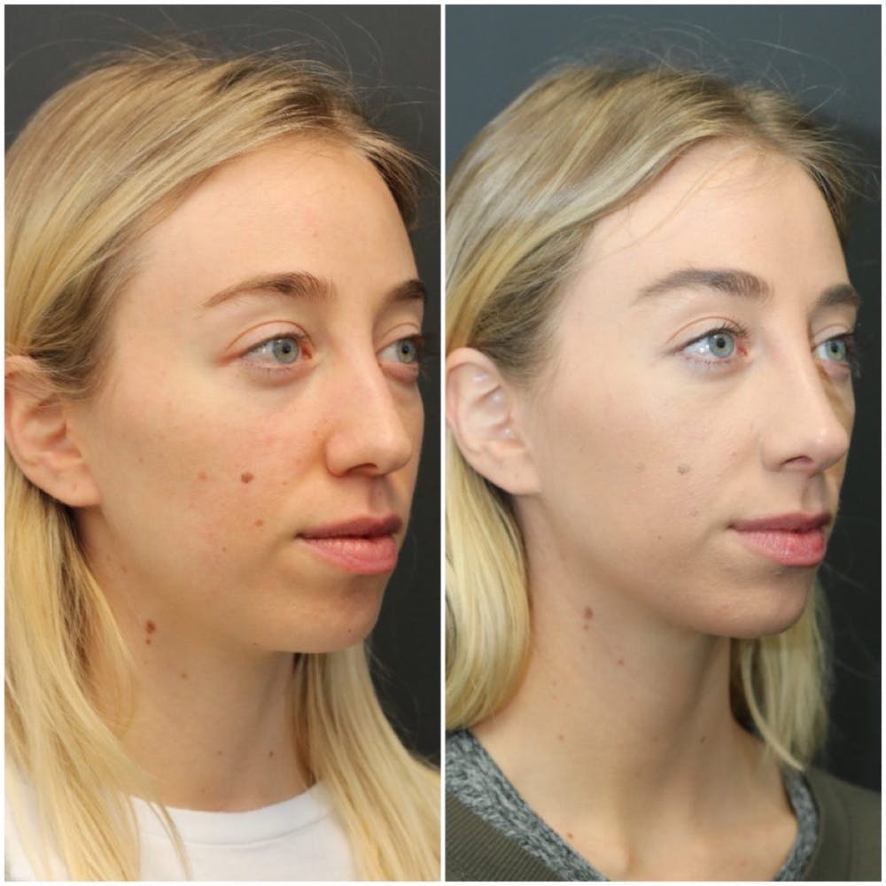 Aesthetic Facial Balancing Before & After Gallery - Patient 11681594 - Image 2