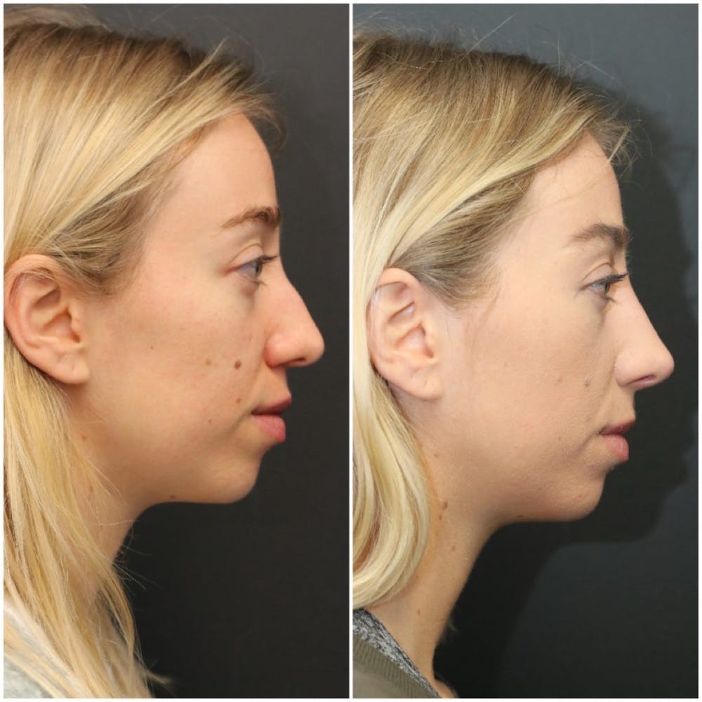 Aesthetic Facial Balancing Before & After Gallery - Patient 11681594 - Image 3