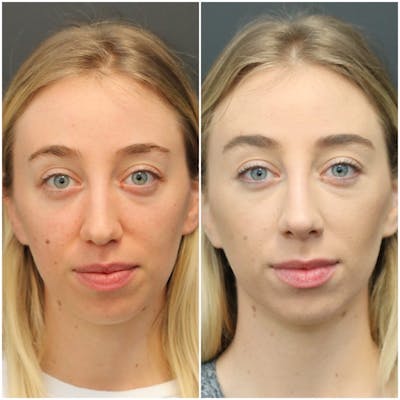 Aesthetic Facial Balancing Before & After Gallery - Patient 11681594 - Image 1