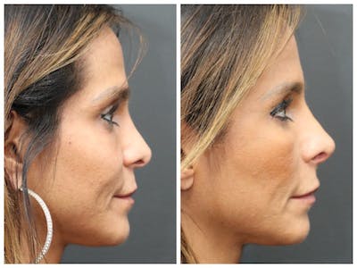 Aesthetic Facial Balancing Before & After Gallery - Patient 11681595 - Image 2
