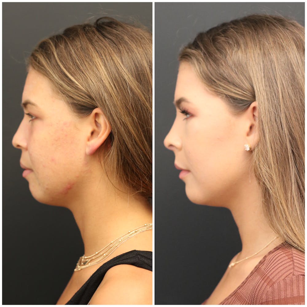Aesthetic Facial Balancing Before & After Gallery - Patient 11681596 - Image 3