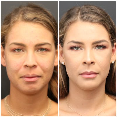Aesthetic Facial Balancing Before & After Gallery - Patient 11681596 - Image 1