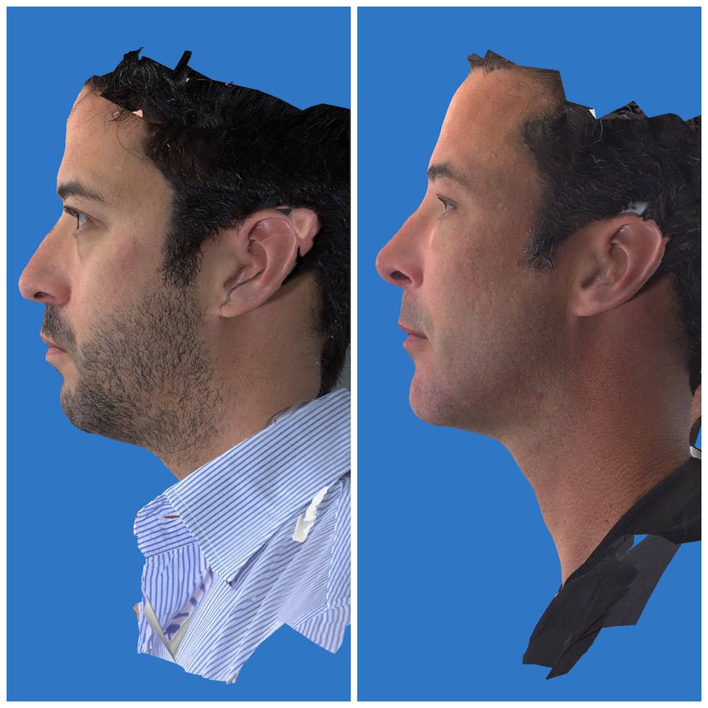 Aesthetic Facial Balancing Before & After Gallery - Patient 11681597 - Image 3