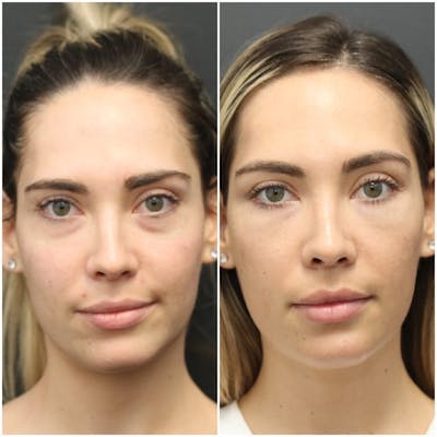 Aesthetic Facial Balancing Before & After Gallery - Patient 11681599 - Image 1