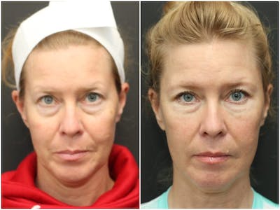 Aesthetic Facial Balancing Before & After Gallery - Patient 11681601 - Image 1