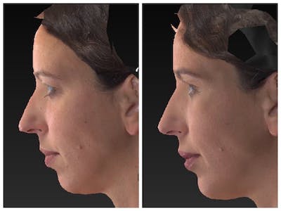 Aesthetic Facial Balancing Before & After Gallery - Patient 11681605 - Image 1