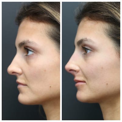 Aesthetic Facial Balancing Before & After Gallery - Patient 11681607 - Image 1