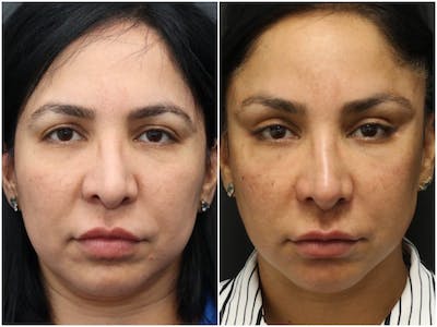 Aesthetic Facial Balancing Before & After Gallery - Patient 11681608 - Image 1