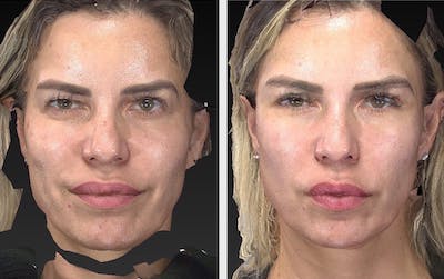 Aesthetic Facial Balancing Before & After Gallery - Patient 11681610 - Image 1