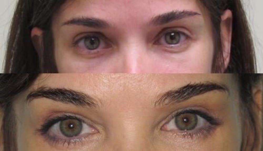 Eyelid Surgery Before & After Gallery - Patient 11681628 - Image 1