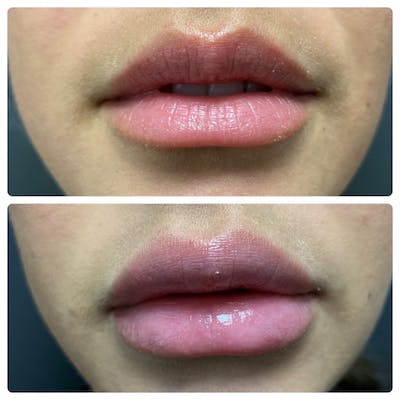 Lip Augmentation Before & After Gallery - Patient 11681654 - Image 1