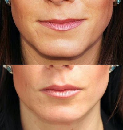 Lip Augmentation Before & After Gallery - Patient 11681657 - Image 1