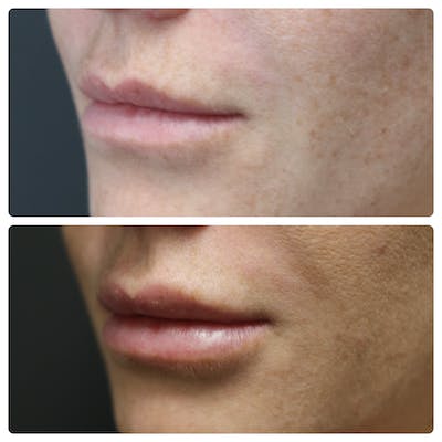 Lip Augmentation Before & After Gallery - Patient 11681658 - Image 1