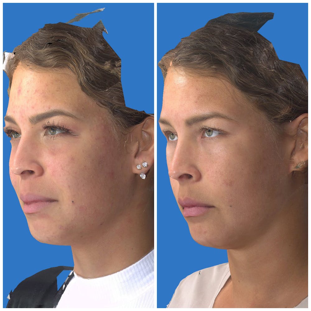 Photo Facial Before & After Gallery - Patient 11681661 - Image 3