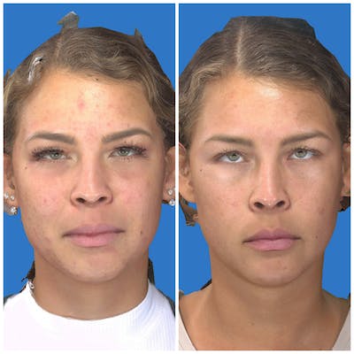 Photo Facial Before & After Gallery - Patient 11681661 - Image 1