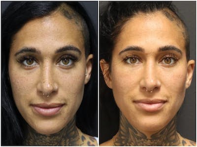 Photo Facial Before & After Gallery - Patient 11681663 - Image 1