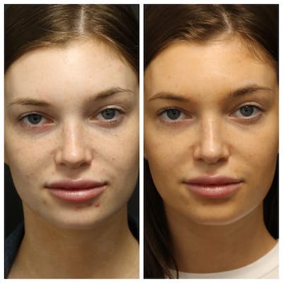 Photo Facial Before & After Gallery - Patient 11681664 - Image 1
