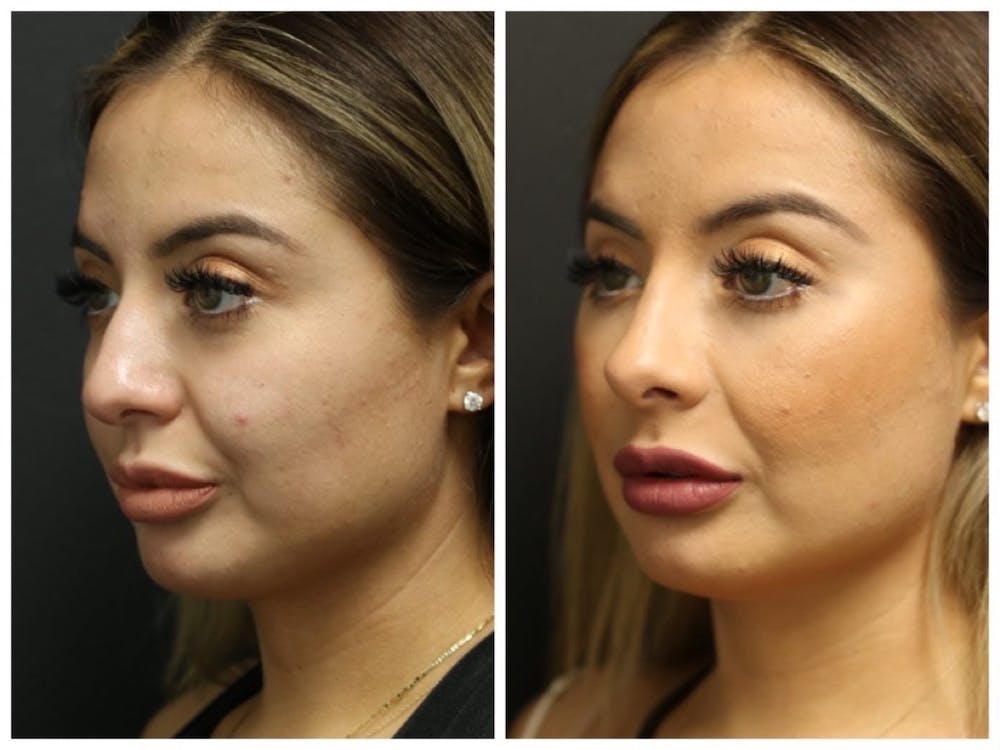 Rhinoplasty Before & After Gallery - Patient 11681677 - Image 1