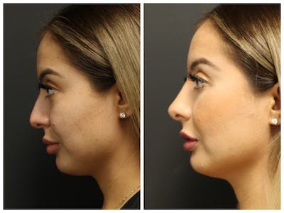 Rhinoplasty Before & After Gallery - Patient 11681677 - Image 2