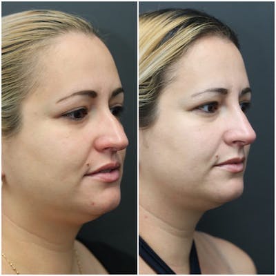 Rhinoplasty Before & After Gallery - Patient 11681678 - Image 1