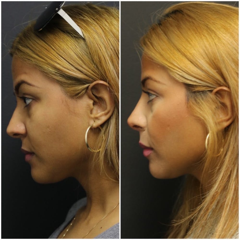 Rhinoplasty Before & After Gallery - Patient 11681681 - Image 3