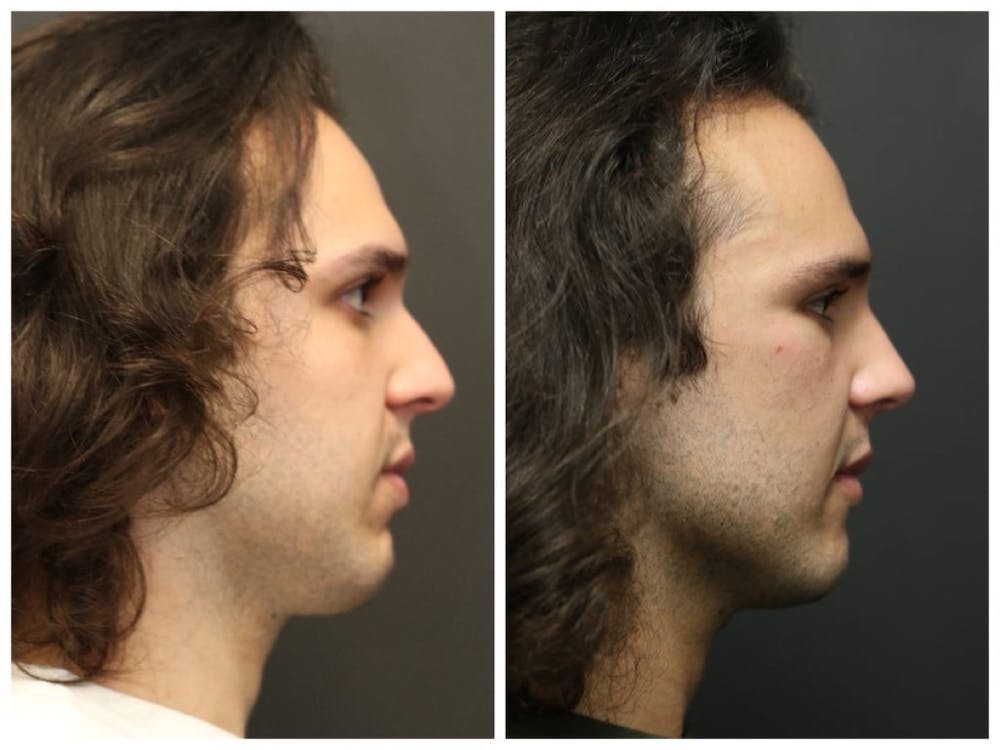 Rhinoplasty Before & After Gallery - Patient 11681685 - Image 3