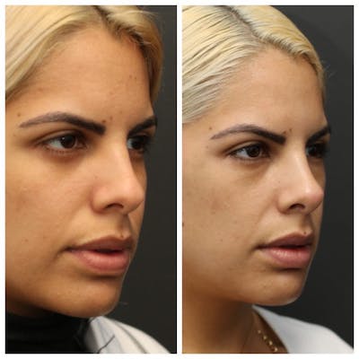 Rhinoplasty Before & After Gallery - Patient 11681686 - Image 1