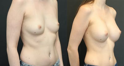 Breast Augmentation Before & After Gallery - Patient 11681775 - Image 1