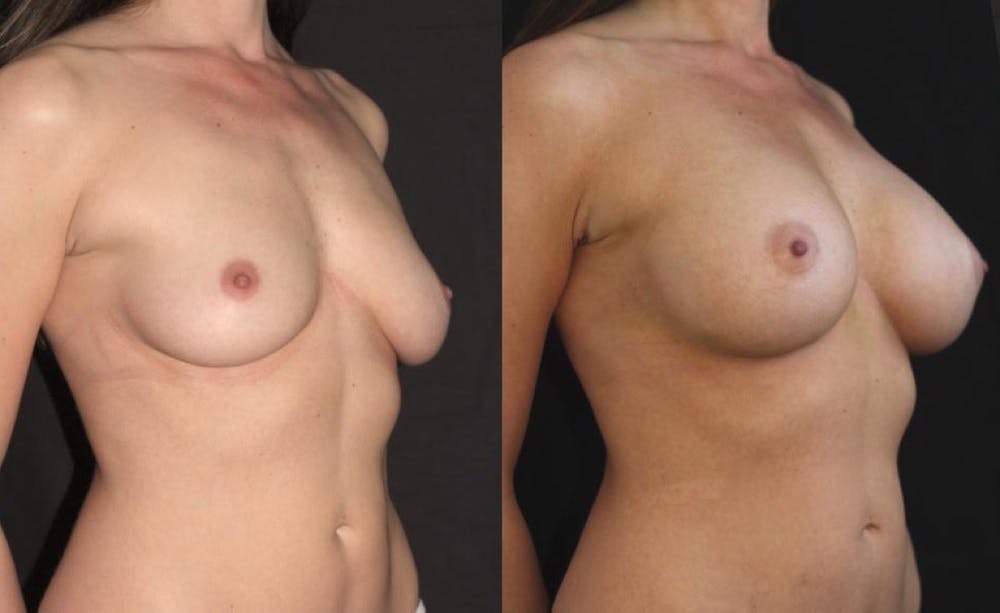 Breast Augmentation Before & After Gallery - Patient 11681776 - Image 4