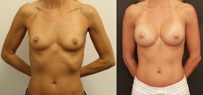Breast Augmentation Before & After Gallery - Patient 11681779 - Image 1
