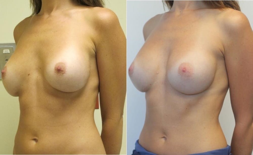 Breast Revision Before & After Gallery - Patient 11681812 - Image 3