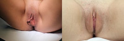 Labiaplasty Before & After Gallery - Patient 11681829 - Image 1